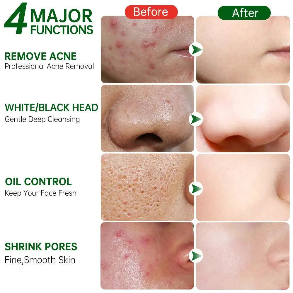 Tea Tree Clay Mask For Acne And Clear Skin 50ml Daily Use