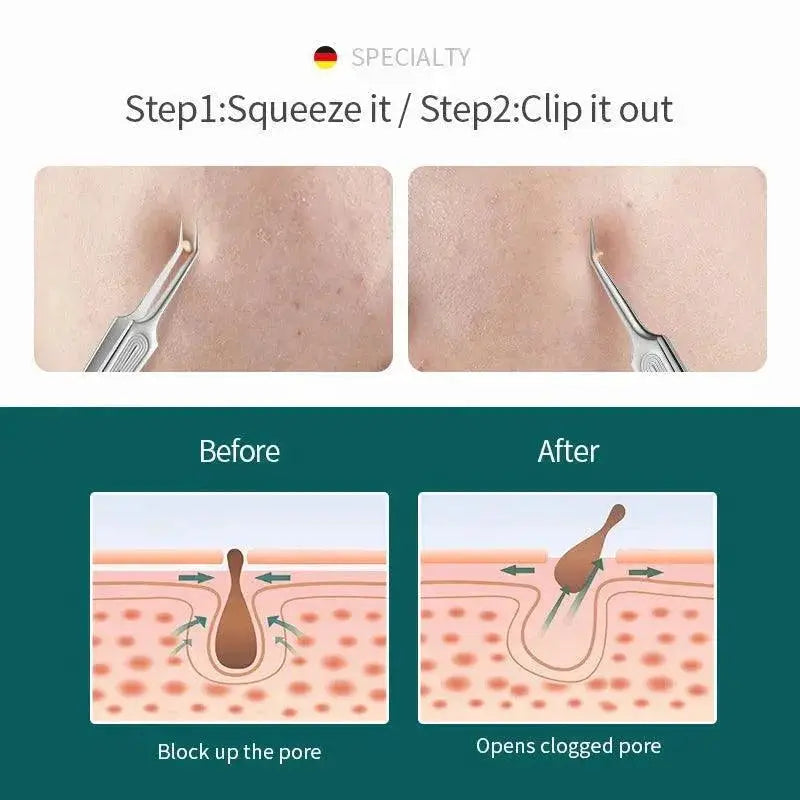 Professional Blackhead Pimple Extractor Kit For Clear Skin