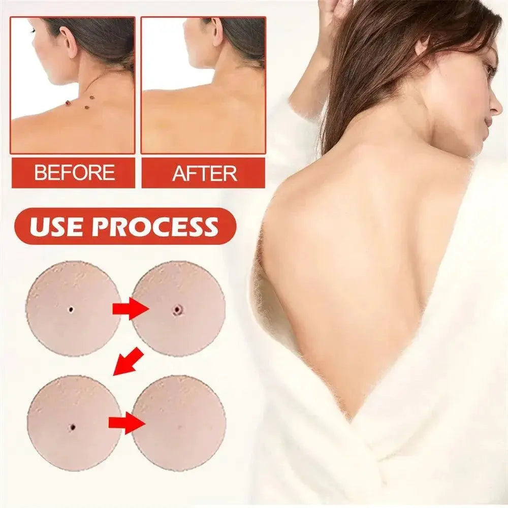 Acne Master Hydrocolloid Patches For 24 Hour Healing