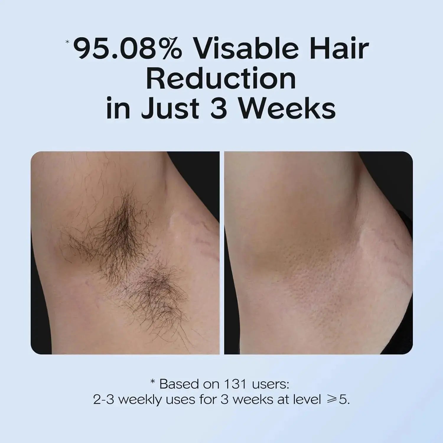 Pain-Free IPL Hair Removal for Home Use