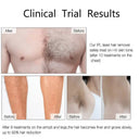 Pain Free IPL Hair Removal For Women