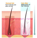 Painless IPL Hair Removal For Women