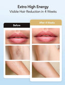 Painless IPL Hair Removal for Women
