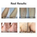 Pain Free IPL Hair Removal For Women