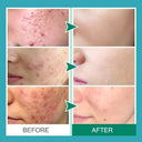 PWYUMAN Acne Cream for Acne Prone Skin