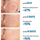 PWYUMAN Acne Cream for Acne Prone Skin