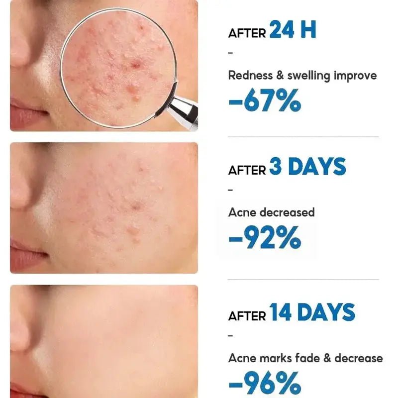 PWYUMAN Acne Cream for Acne Prone Skin