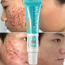 PWYUMAN Acne Cream for Acne Prone Skin