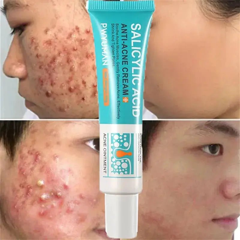 PWYUMAN Acne Cream for Acne Prone Skin