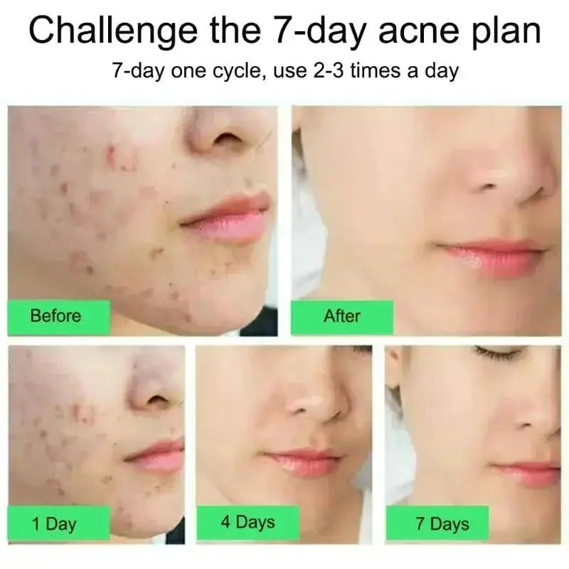 PWYUMAN Acne Cream for Acne Prone Skin