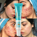 PWYUMAN Acne Cream for Acne Prone Skin