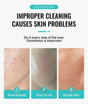 PWYUMAN Acne Cream for Acne Prone Skin