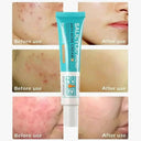 PWYUMAN Acne Cream for Acne Prone Skin