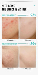 PWYUMAN Acne Cream for Acne Prone Skin