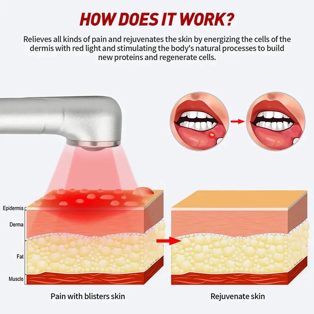 Red Light Wand For Cold Sores Healing