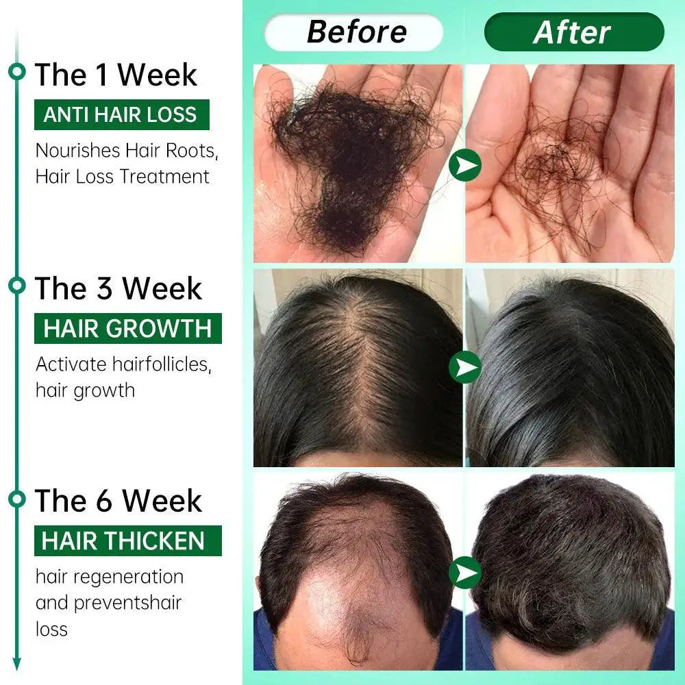 Rosemary Ginger Hair Growth Oil For Hair Loss Solution - OurLum.com