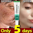 Salicylic Serum for Oily Skin and Pores