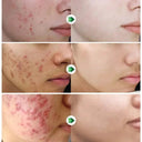 Salicylic Serum for Oily Skin and Pores