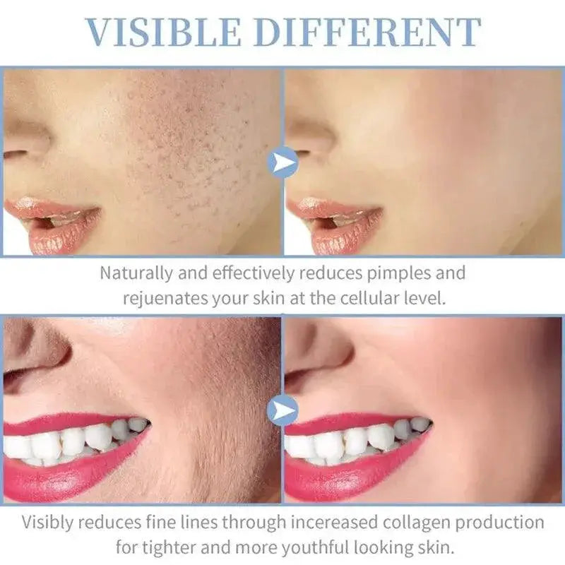 Skin Therapy Device Acne And Wrinkle Removal Technology