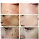 Spot Whitening Cream For Dark Spots