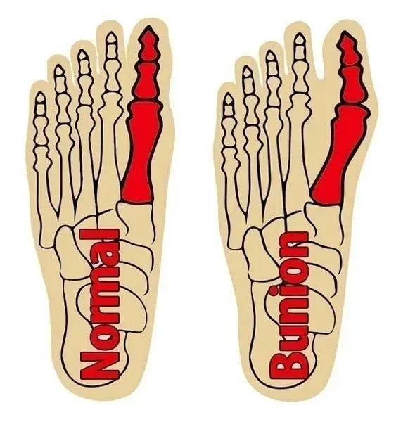 Ultimate Comfort Gel Bunion Sleeve For Happy Feet Relief