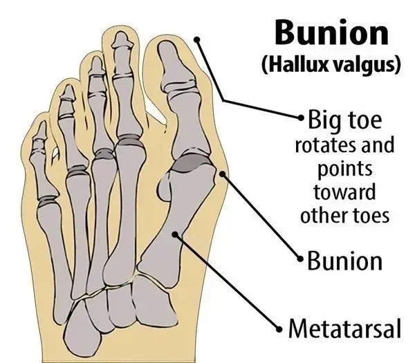 Ultimate Comfort Gel Bunion Sleeve For Happy Feet Relief