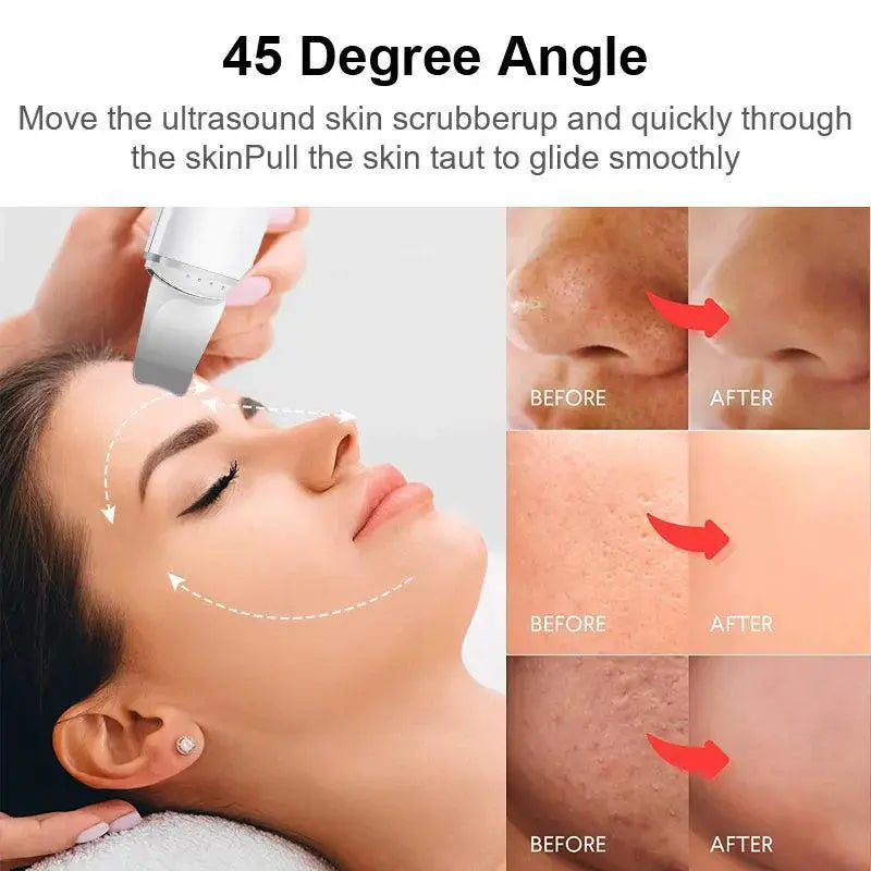 Ultrasonic Skin Scrubber For Advanced Skin Renewal At Home