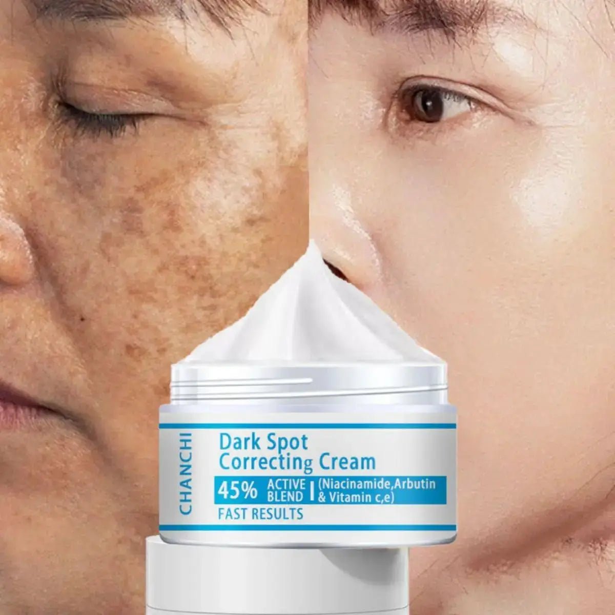 Whitening Freckles Cream for Melasma