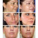 Whitening Freckles Cream for Melasma