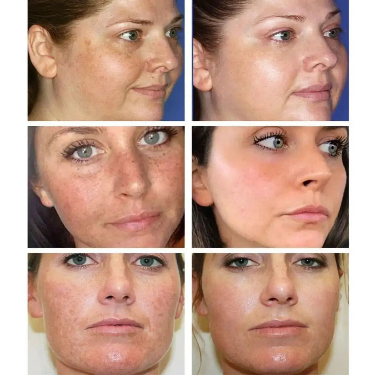 Whitening Freckles Cream for Melasma